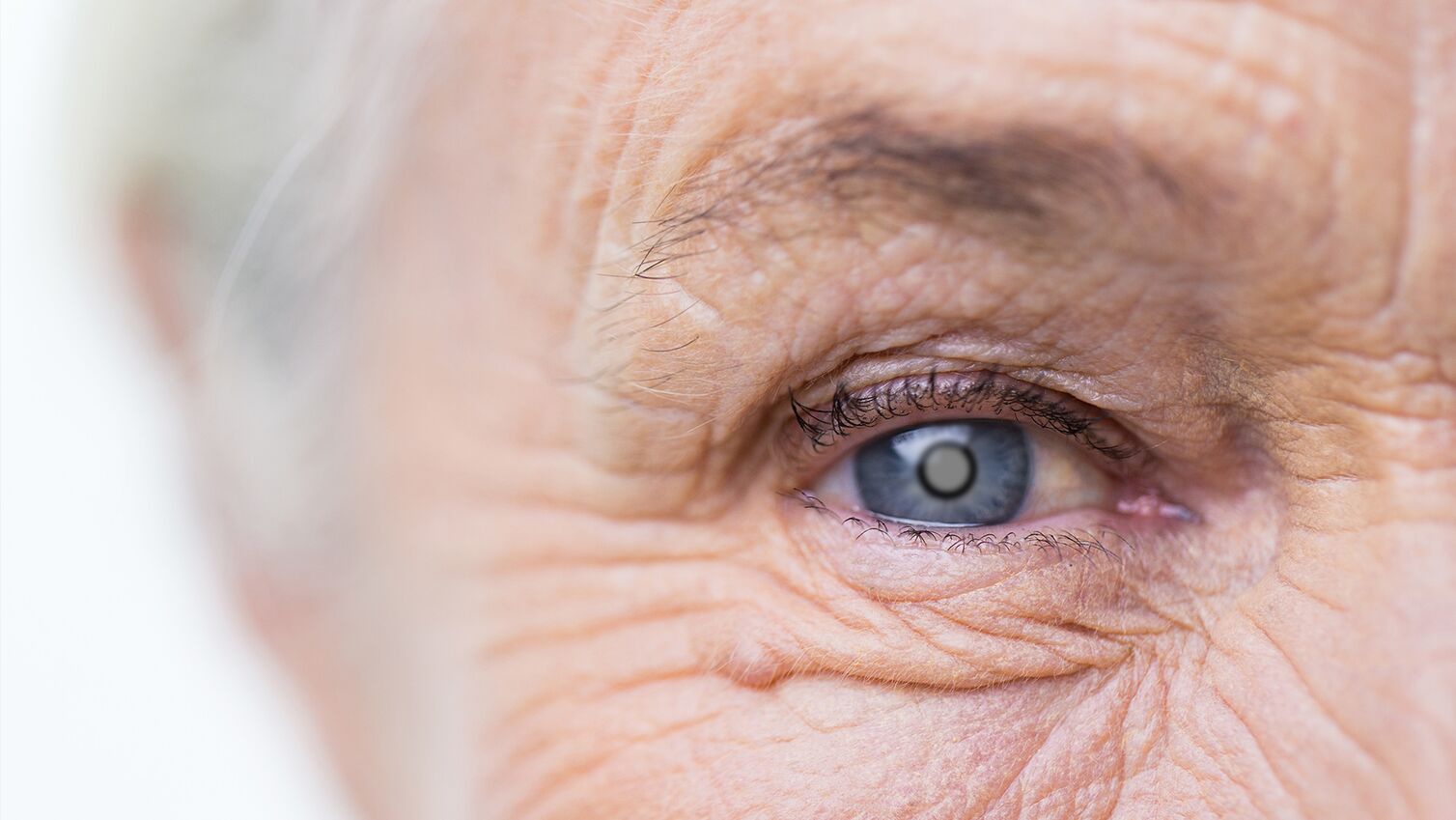 Symbolbild zur Augenkranheit Grüner Star bei einer älteren Frau