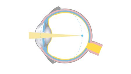 Zeichnung eines Augenquerschnittes zur Augenkrankheit Kurzsichtigkeit