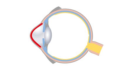 Zeichnung eines Augenquerschnittes zur Augenkrankheit Keratakonus