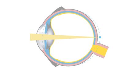 Zeichnung eines Augenquerschnittes zur Augenkrankheit Weitsichtigkeit