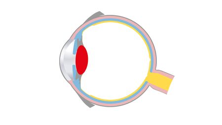 Zeichnerische Darstellung der Augenkrankheit Grauer Star in einem Augenquerschnitt