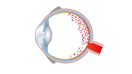 Zeichnung eines Augenquerschnittes zur Augenkrankheit Retinitis-Pigmentosa